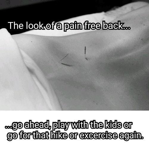 Acupuncture needles in lower back